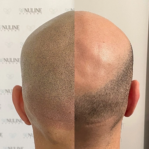 Nuline Academy - Tricopigmentazione