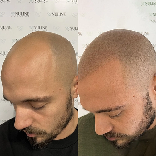 Nuline Academy - Tricopigmentazione