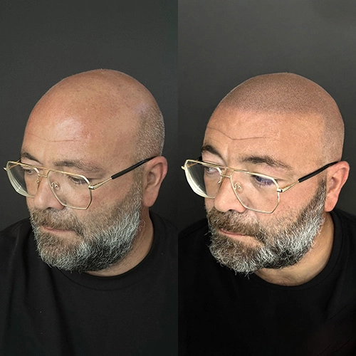 Nuline Academy - Tricopigmentazione