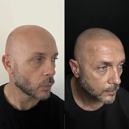 Nuline Academy - Tricopigmentazione